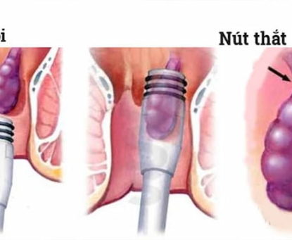 Điều trị bệnh trĩ bằng phương pháp thắt búi trĩ bằng vòng thun
